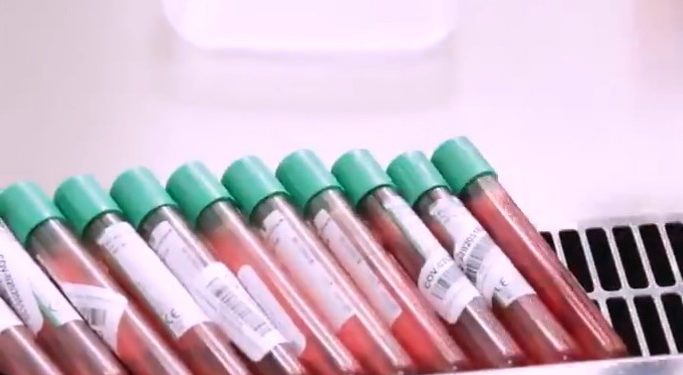 El equipo de investigadores de la Universidad de Oxford que trabajan para desarrollar una vacuna contra el Sars Cov 2 declararon al diario médico The Lancet que no hay problemas de seguridad y la vacuna estimuló una fuerte respuesta inmune