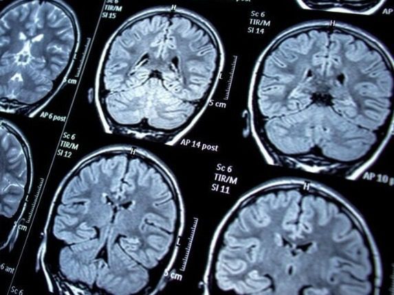 La Península de Yucatán es la región con mayor crecimiento de la enfermedad de Parkinson, en lo que va del año
