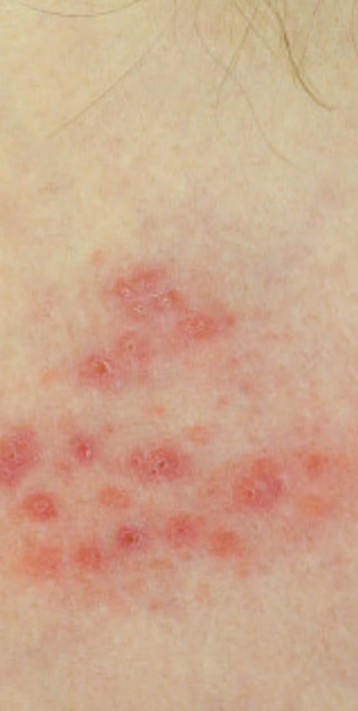 En Quintana Roo y Yucatán se registra un brote de herpes genital, al superar en más del 30 por ciento el número de contagiados