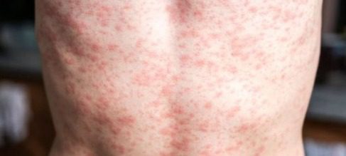 En Yucatán la tosferina se quintuplicó, la leptospirosis y la diabetes mellitus tipo 1 se duplicaron, sin embargo, el Alzheimer decreció en cerca del 50 por ciento