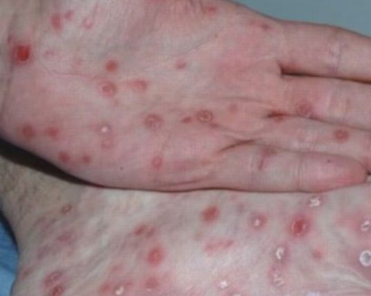 Confirman 20 casos de gonorrea en Yucatán en lo que va del año / En el país hay 906 casos confirmados acumulados de Infección Gonocócica del Tracto Genitourinario