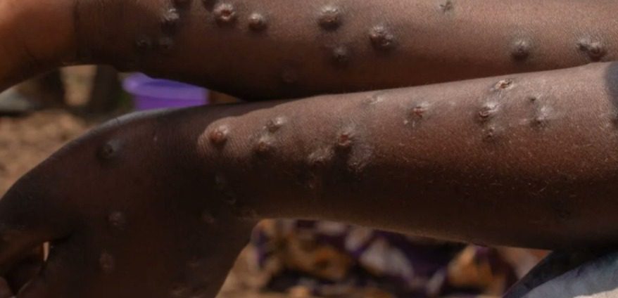 Por quinta semana consecutiva, en Yucatán se registraron dos nuevos contagios casos de Mpox (viruela símica) / El Estado se mantiene como la segunda entidad con mayor incidencia