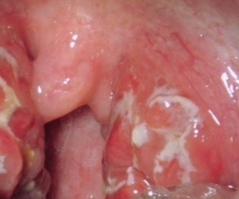 Hasta ahora en Yucatán se han registrado 43 casos confirmados acumulados de gonorrea, la cifra más alta en 15 años, según datos de la SSF