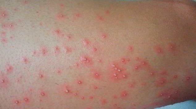 En Quintana Roo y Yucatán prevalece un brote de escabiosis, es decir, de sarna en humanos / En Yucatán hay 529 contagiados / En Quintana Roo 815