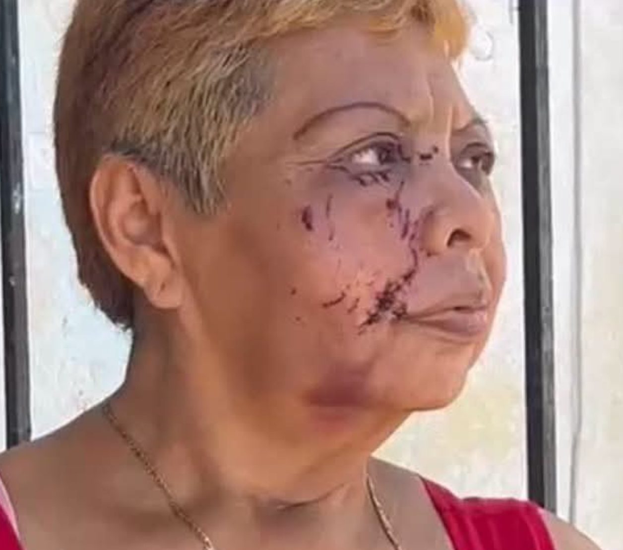 Hay denuncia contra propietario de perros que atacaron a una mujer y la mordieron en el rostro, brazo y pierna en la colonia Bojórquez / Ambos están en manos del Ayuntamiento de Mérida